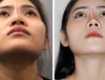 Chỉnh sửa mũi bị hỏng sau nâng – Giải pháp khắc phục triệt để biến chứng