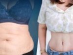 Hút mỡ bụng toàn phần: Sở hữu body S Line tức thì sau 60 phút
