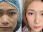 Nâng mũi bằng sụn tự thân: Không đau – Đẹp vĩnh viễn