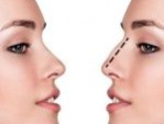 Hạ thấp sống mũi gồ – Trả lại dáng mũi thanh thoát, tự nhiên