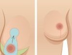 Phẫu thuật thu nhỏ vú phì đại – Tạm biệt vòng 1 quá khổ