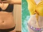 Hút mỡ bụng toàn phần – Giải pháp lấy lại vòng eo con kiến nhanh chóng