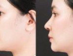 Nâng mũi cấu trúc Thai Shape – Bí quyết mũi đẹp chuẩn Thái