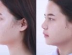 Chi phí nâng mũi sụn sườn tại Thẩm mỹ Bệnh viện Hồng Hà