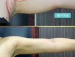 Hút mỡ bắp tay giá bao nhiêu? 3 Kinh nghiệm tiết kiệm chi phí