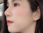 Quá trình nâng mũi bọc sụn an toàn, đạt chuẩn Bộ Y Tế