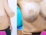 Treo ngực sa trễ giá bao nhiêu – 2 Cách nhận giá tốt