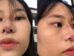 Bị sẹo lồi sau khi nâng mũi: Nguyên nhân và cách khắc phục