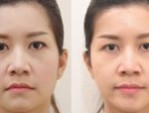 Căng chỉ da mặt bao lâu thì đẹp – 4 Cách kéo dài hiệu quả
