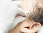 Căng chỉ da mặt được bao lâu? Bí quyết có làn da đẹp