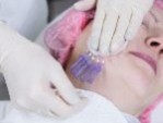 Căng da mặt bằng chỉ collagen trẻ hóa làn da, xóa mờ nếp nhăn