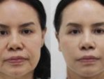 Căng da mặt bao nhiêu tiền? 5 Yếu tố ảnh hưởng đến giá