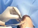 Cắt tuyến mồ hôi nách: Những nguy cơ tiềm ẩn bạn có biết?