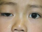 Chỉnh hình sụp mí mắt bẩm sinh khắc phục khuyết điểm hiệu quả