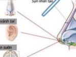 Có nên nâng mũi bằng bọc sụn không và những điều cần biết