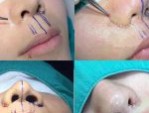 Cuộn cánh mũi có phá tướng không? Có mất lộc không?