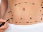 Hút mỡ bụng phải nịt bụng bao lâu – Chăm sóc hồi phục nhanh