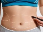 Hút mỡ bụng có nguy hiểm không – Lưu ý quan trọng
