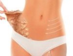 Hút mỡ bụng dưới dưỡng bao lâu? Cách chăm sóc đúng chuẩn