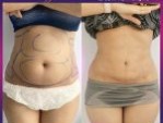 Hút mỡ bụng có sinh em bé được không – Chuyên gia giải đáp