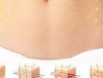 Hút mỡ bụng trên bao lâu thì đẹp – 3 lưu ý sau hút mỡ nhanh lành