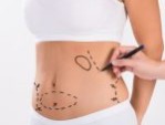Hút mỡ có an toàn không? Có để lại di chứng gì không?