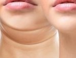 Hút mỡ nọng cằm giá bao nhiêu? 4 Yếu tố ảnh hưởng chi phí