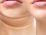 Hút mỡ nọng cằm: Loại bỏ cằm 2 ngấn chỉ sau 60 phút
