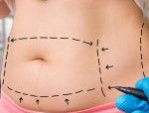 Hút mỡ xong có béo lại không – Cách duy trì vóc dáng hiệu quả