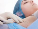 Hút nội soi tuyến mồ hôi nách: Loại bỏ mùi hôi chỉ sau 1 lần