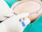 Hút tuyến mồ hôi nách Laser Ultra Dry không phẫu thuật
