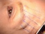 Nâng cung mày không phẫu thuật – Lưu ý chăm sóc