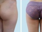 Nâng mông ở đâu đẹp? Hồng Hà địa chỉ nâng vòng 3 uy tín
