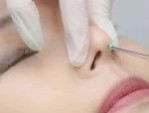Nâng mũi bằng chỉ có đau không – 4 loại chỉ nâng mũi thông dụng