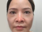 Nâng mũi bao lâu hết sưng – Lưu ý nhanh lành, đẹp