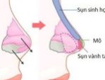 Nâng mũi bọc sụn tai – Giải pháp cho dáng mũi đẹp tự nhiên