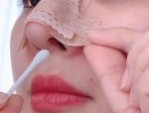 Nâng mũi mấy ngày tháo băng, tháo nẹp mũi