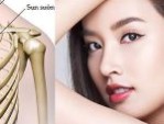 Nâng mũi sụn sườn có vĩnh viễn không – Những điều cần biết