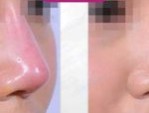 Nâng mũi xong bị đỏ đầu mũi do đâu? Cách xử lý triệt để