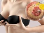 Nâng ngực giữ được bao lâu? 4 Yếu tố ảnh hưởng