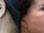 Phẫu thuật căng da mặt nội soi – 90 Phút trẻ lại 10 năm tuổi