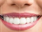 Phẫu thuật cười hở lợi bao lâu thì lành – 4 Lưu ý quan trọng cần biết