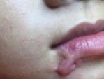 Sửa sẹo môi hết bao nhiêu tiền – 4 yếu tố ảnh hưởng tới chi phí