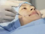 Tạo má lúm đồng tiền có vĩnh viễn không – Chuyên gia giải đáp