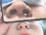 Thu nhỏ cánh mũi có ảnh hưởng gì không? Chuyên gia giải đáp