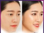 Cắt mí mắt có kịp lành đẹp đón Tết- Bác sĩ Daniel Nguyễn đáp