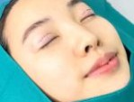 Cắt mí mắt sau bao lâu thì lành, đẹp đón tết