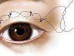Có nên bấm mí mắt không – Dr.Daniel Nguyễn giải đáp