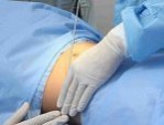 Địa chỉ hút mỡ bụng uy tín – Thẩm mỹ Bệnh viện Hồng Hà