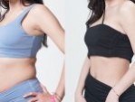 Hút mỡ bụng bao lâu hồi phục – 4 Tip chăm sóc vết thương
